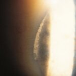 Clinical eye photograph illustrating Vogt Limbal Girdle