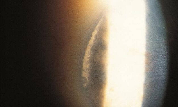 White Limbal Girdle of Vogt: The Chalky Crescent at the Limbus That Is Often Mistaken for Arcus