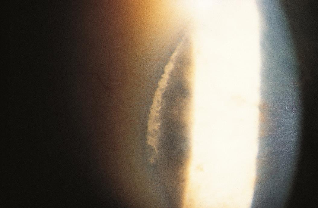 Clinical eye photograph illustrating Vogt Limbal Girdle