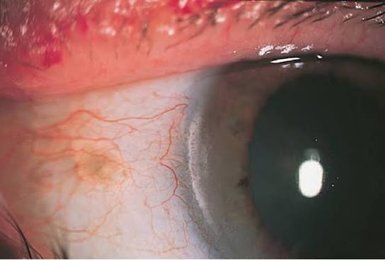Clinical eye photograph illustrating Vogt Limbal Girdle