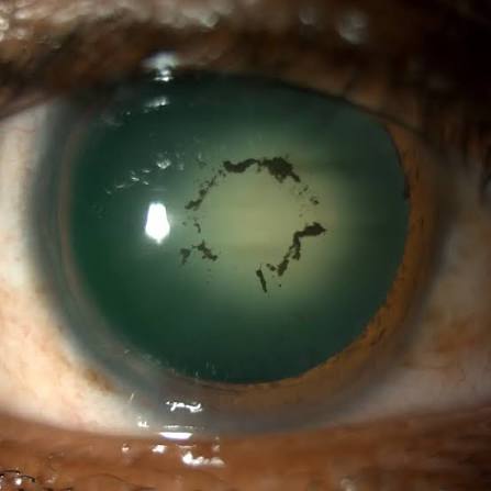 Clinical eye photograph illustrating Vossius Ring Traumatic Cataract Sign
