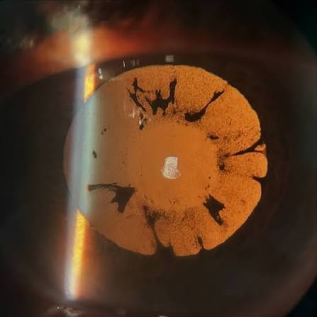 Clinical eye photograph illustrating Vossius Ring Traumatic Cataract Sign