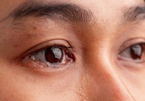 Clinical image illustrating Watery Eye in Adults