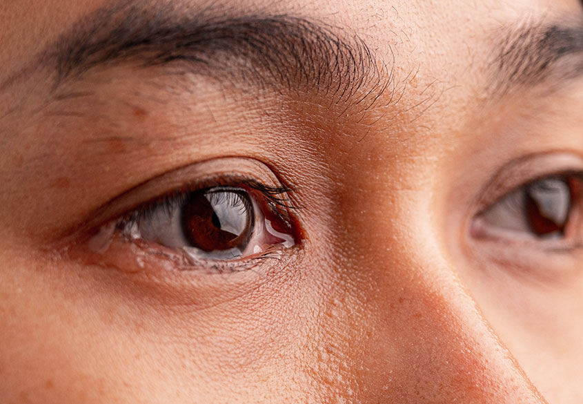 Clinical image illustrating Watery Eye in Adults
