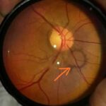 Clinical eye photograph illustrating Weiss Ring Posterior Vitreous Detachment