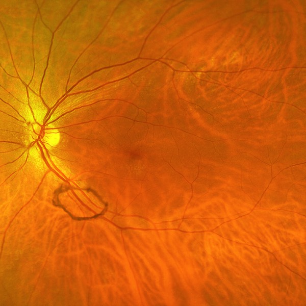 Clinical eye photograph illustrating Weiss Ring Posterior Vitreous Detachment