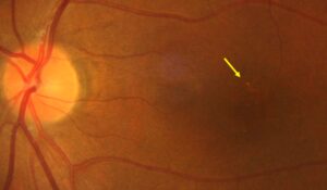 Clinical eye photograph illustrating Welding Arc Maculopathy Photic Retinal Injury