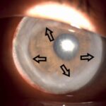Clinical eye photograph illustrating Wessely Immune Ring