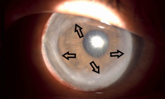 Wessely Ring: The Immune Ring in the Corneal Stroma
