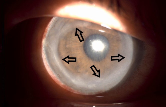 Clinical eye photograph illustrating Wessely Immune Ring