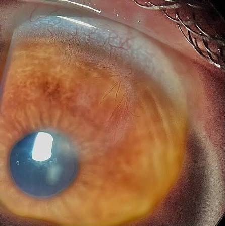 Clinical eye photograph illustrating Wessely Immune Ring