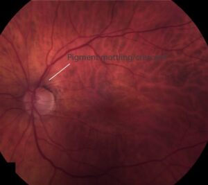 Clinical image illustrating Wet vs Dry AMD