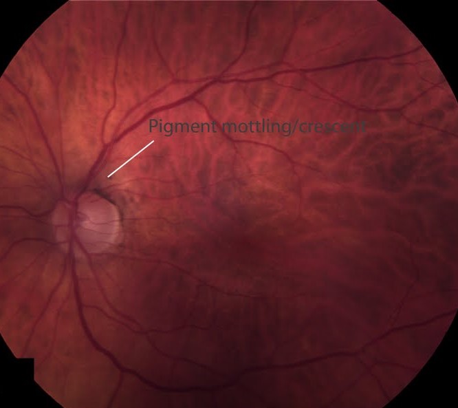 Clinical image illustrating Wet vs Dry AMD