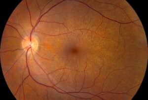 Clinical eye photograph illustrating X Linked Retinitis Pigmentosa Rpgr Carriers