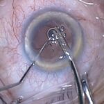 Clinical eye photograph illustrating Zonular Dehiscence Cataract Surgery Management
