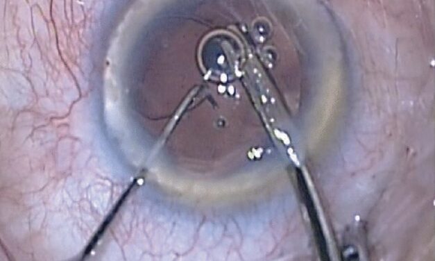 Zonular Dehiscence During Cataract Surgery: Managing a Weakened Foundation