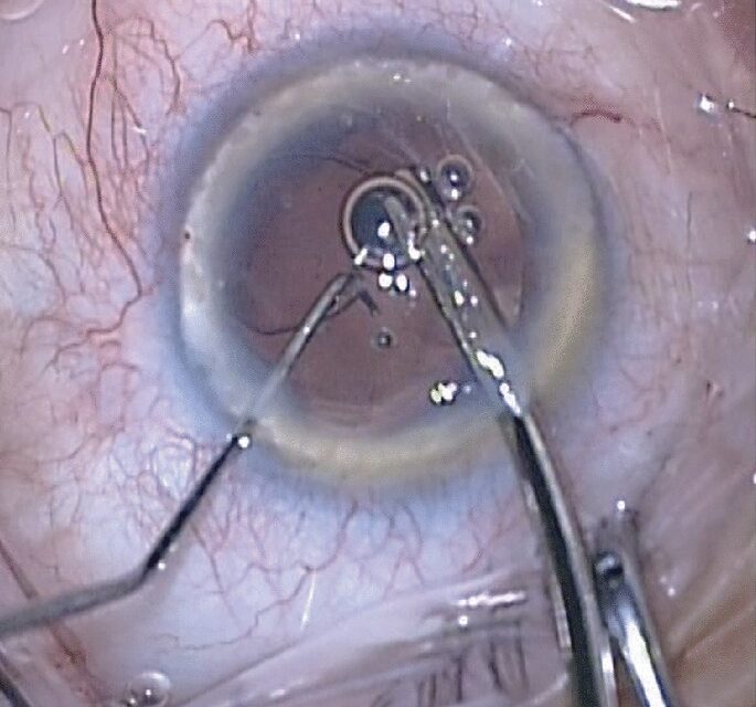 Zonular Dehiscence During Cataract Surgery: Managing a Weakened Foundation