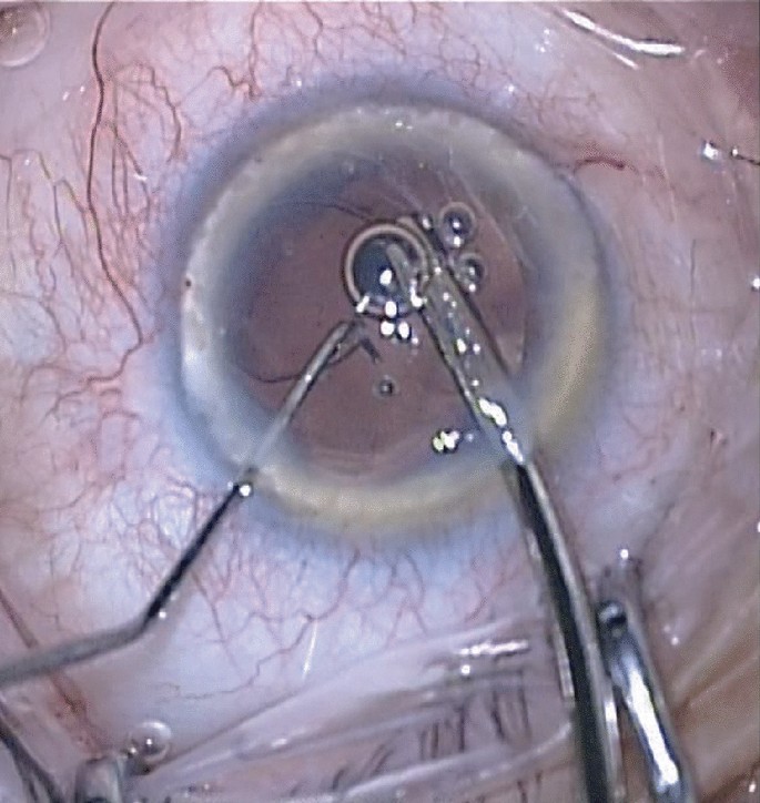 Clinical eye photograph illustrating Zonular Dehiscence Cataract Surgery Management