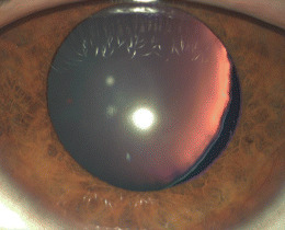 Clinical eye photograph illustrating Zonular Dehiscence Cataract Surgery Management
